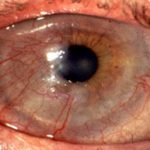 Corneal neovascularization